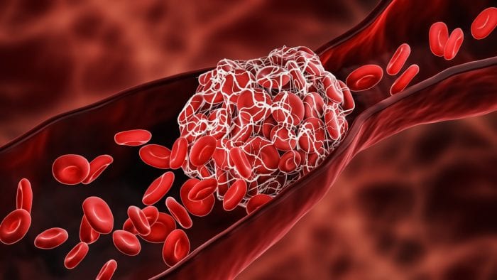 Blood Clot - Neurological Disorders