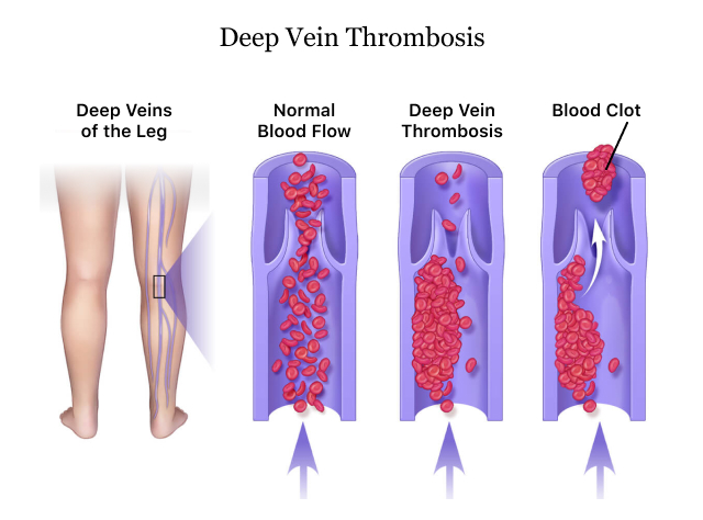 Blood Clot - Neurological Disorders