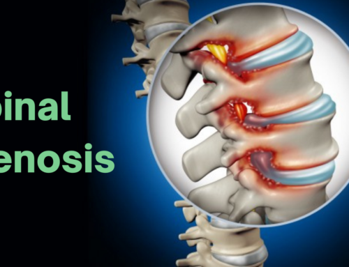 Spinal Stenosis – Causes, Symptoms, Treatment