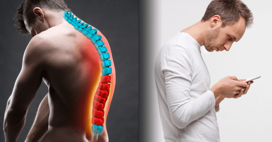 What Is Cervical Kyphosis? Symptoms, Causes, And Treatment