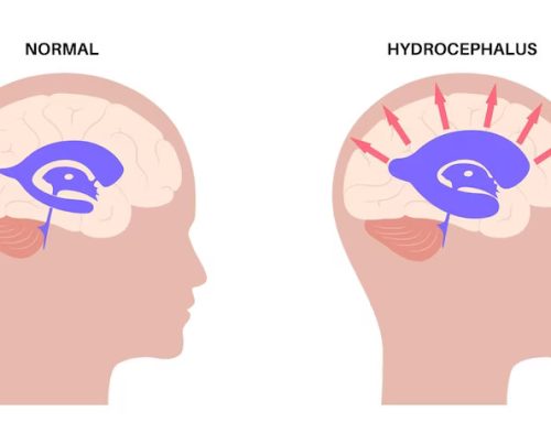 Hydrocephalus – Symptoms, Causes & Treatment